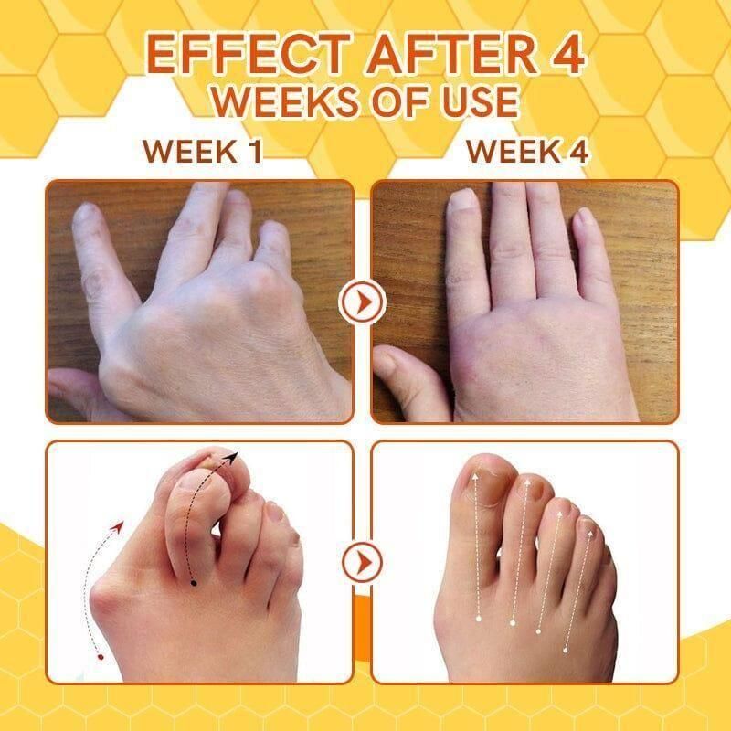 Bee Venom Spider Veins Spray (Buy 1 get 1 Free) summer offer